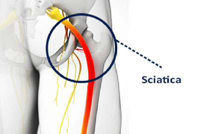 sciatica chiropractor help